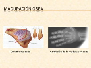 MADURACIÓN ÓSEA
Crecimiento óseo Valoración de la maduración ósea
 