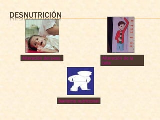 DESNUTRICIÓN
Alteración del peso Alteración de la
talla
Nanismo nutricional
 