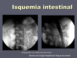 Isquemia intestinal Servicio de Cirugía Hospital San Roque de oonnet Angiografía con obstrucciones leves 