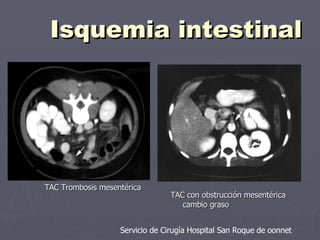 Isquemia intestinal Servicio de Cirugía Hospital San Roque de oonnet TAC Trombosis mesentérica TAC con obstrucción mesentérica cambio graso 