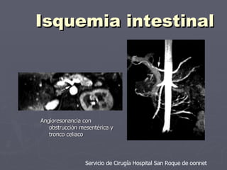 Isquemia intestinal Servicio de Cirugía Hospital San Roque de oonnet Angioresonancia con obstrucción mesentérica y tronco celiaco 