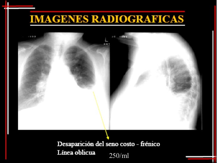 Semiolog a Del Derrame Pleural