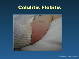 Celulitis Flebitis 