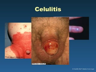 Celulitis 