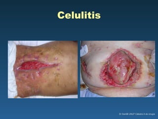 Celulitis 