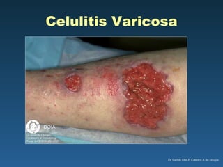 Celulitis Varicosa 