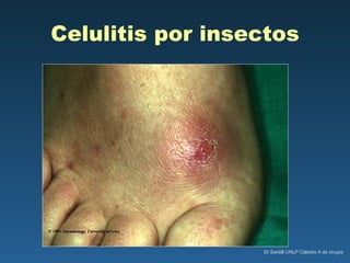 Celulitis por insectos 