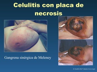 Celulitis con placa de necrosis Gangrena sinérgica de Meleney 