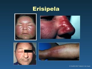 Erisipela 