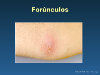 Forúnculos 