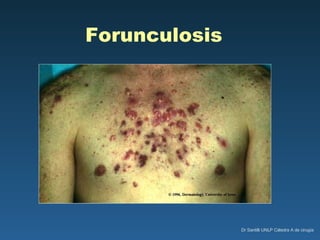 Forunculosis 
