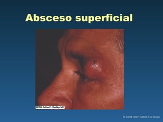 Absceso superficial 