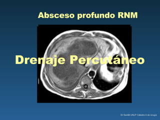 Absceso profundo RNM Drenaje Percutáneo 