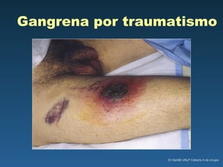 Gangrena por traumatismo 