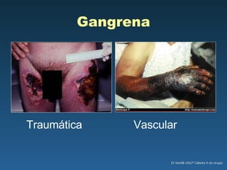 Gangrena Traumática Vascular 