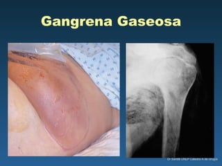Gangrena Gaseosa 