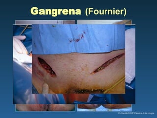 Gangrena   (Fournier) 