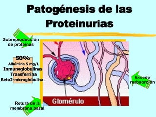 Patogénesis de las Proteinurias 50%  Albúmina   5 mg/L Inmunoglobulinas   Transferrina Beta2-microglobulina .   Excede reabsorción Sobreproducción de proteinas Rotura de la membrana basal 