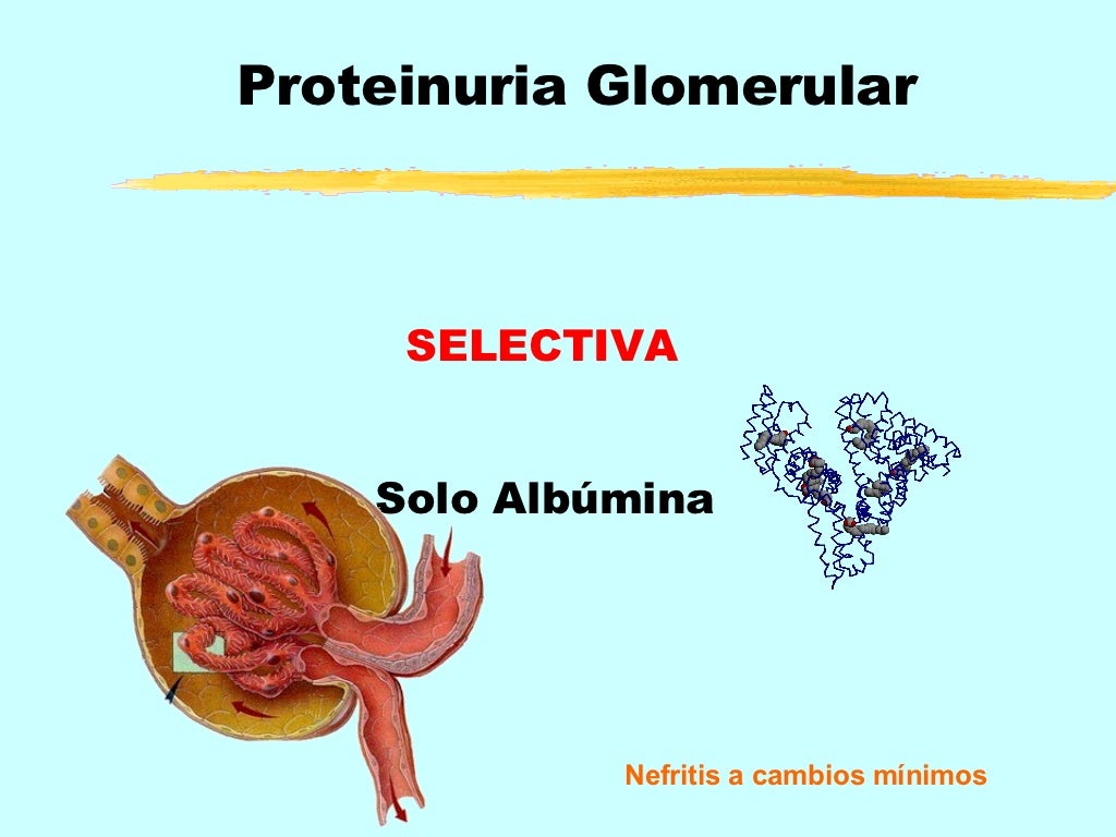 Proteinuria y sus causas