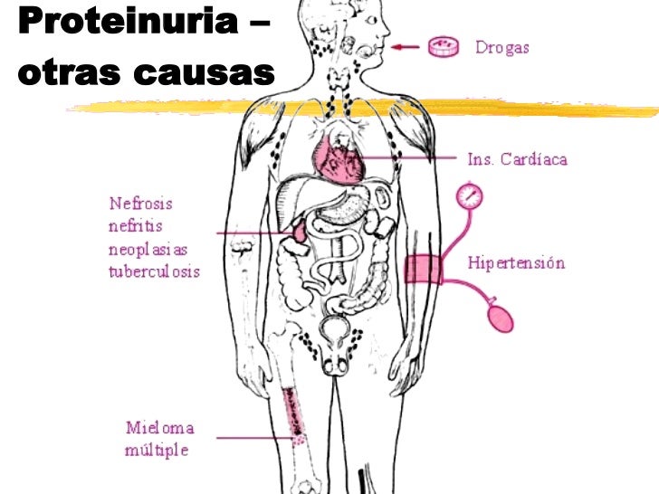 Proteinuria y sus causas