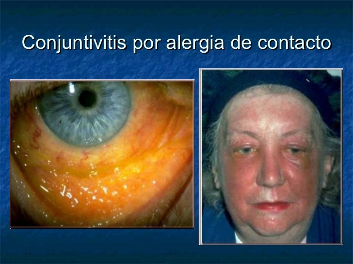 Atopichesky se puede comer la dermatitis que
