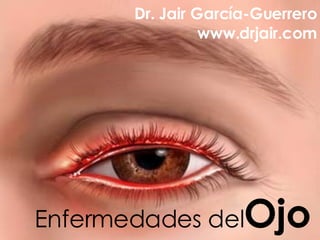 Enfermedades del Ojo Dr. Jair García-Guerrero www.drjair.com 