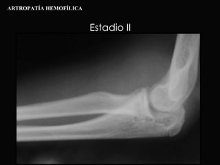 Estadio II ARTROPATÍA HEMOFÍLICA 