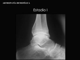 Estadio I ARTROPATÍA HEMOFÍLICA 