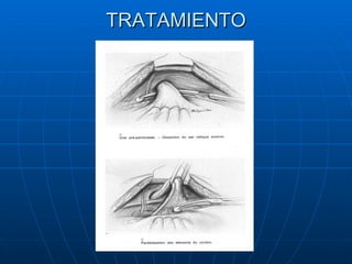 TRATAMIENTO 