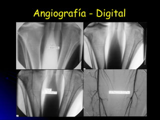 Angiografía - Digital
 