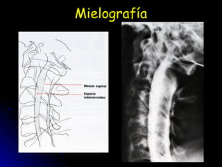 Mielografía
 