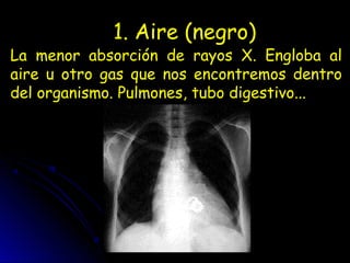 1. Aire (negro)
La menor absorción de rayos X. Engloba al
aire u otro gas que nos encontremos dentro
del organismo. Pulmones, tubo digestivo...
 