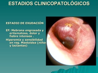 ESTADIOS CLINICOPATOLÓGICOS ESTADIO DE EXUDACIÓN EF: Mebrana engrosada y eritematosa, dolor y fiebre intensos . Hiperemia y sensibilidad en reg. Mastoidea   (niños y lactantes) 