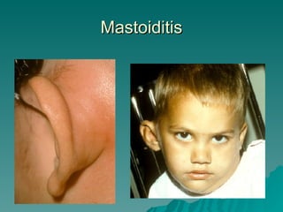 Mastoiditis 