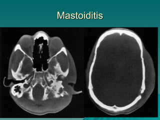 Mastoiditis 