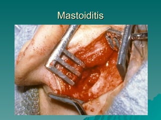 Mastoiditis 