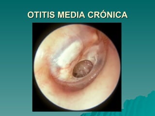 OTITIS MEDIA CRÓNICA 