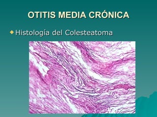 OTITIS MEDIA CRÓNICA Histología del Colesteatoma 