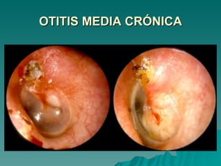 OTITIS MEDIA CRÓNICA 
