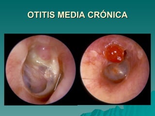 OTITIS MEDIA CRÓNICA 