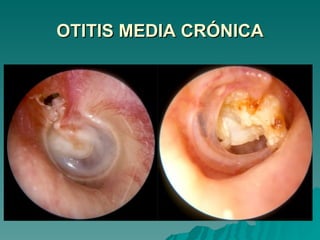 OTITIS MEDIA CRÓNICA 