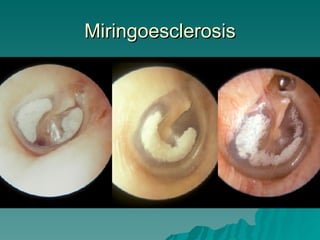 Miringoesclerosis 