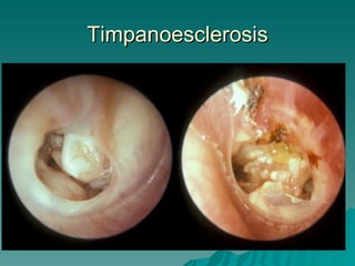 Timpanoesclerosis 
