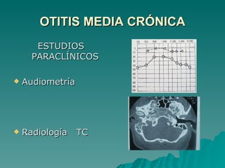 OTITIS MEDIA CRÓNICA ESTUDIOS PARACLÍNICOS Audiometría Radiología  TC 