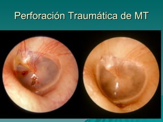 Perforación Traumática de MT 