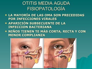 OTITIS MEDIA AGUDA FISIOPATOLOGÍA LA MAYORÍA DE LAS OMA SON PRECEDIDAS POR INFECCIONES VIRALES APARICIÓN SUBSECUENTE DE LA INFECCION BACTERIANA NIÑOS TIENEN TE MÁS CORTA, RECTA Y CON MENOR COMPLIANZA 