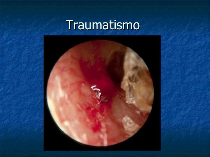 Hematoma Retrocorial Y Síndrome De Down