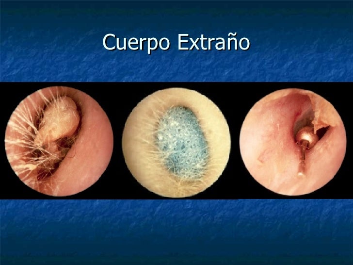 Hematoma Retrocorial Y Síndrome De Down