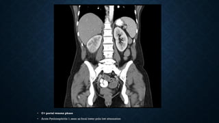 • C+ portal venous phase
• Acute Pyelonephritis 1; seen as focal lower pole low attenuation
 