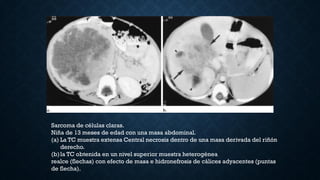 Sarcoma de células claras.
Niña de 13 meses de edad con una masa abdominal.
(a) La TC muestra extensa Central necrosis dentro de una masa derivada del riñón
derecho.
(b)la TC obtenida en un nivel superior muestra heterogénea
realce (flechas) con efecto de masa e hidronefrosis de cálices adyacentes (puntas
de flecha).
 